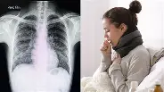 Kipas Angin Saat Tidur Bisa Menyebabkan Paru-Paru Basah, Benarkah?